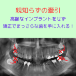 （症例）矯正治療で親知らずを引っぱり出して高額なインプラントを避ける！