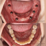 (症例）下顎全顎インプラントブリッジ※外科時画像あり